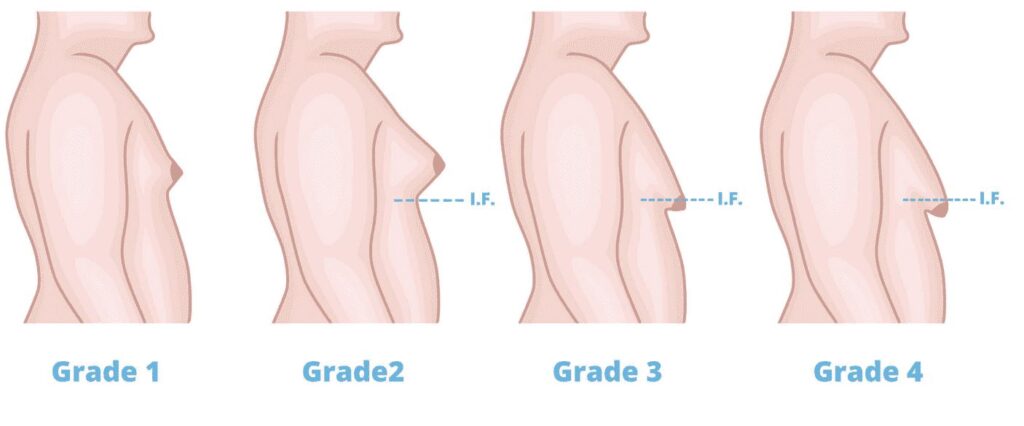 gynecomastia 