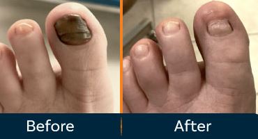 toenail removal healing stages