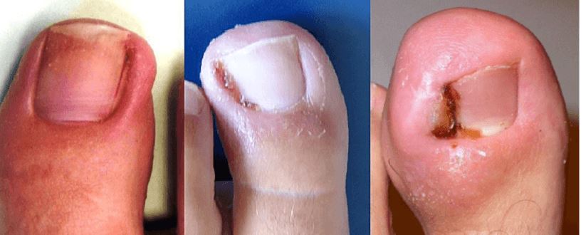 Toenail Removal Healing Stages 